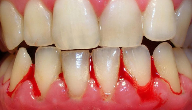 Sưng lợi chảy máu chân răng do các vấn đề trong cơ thể