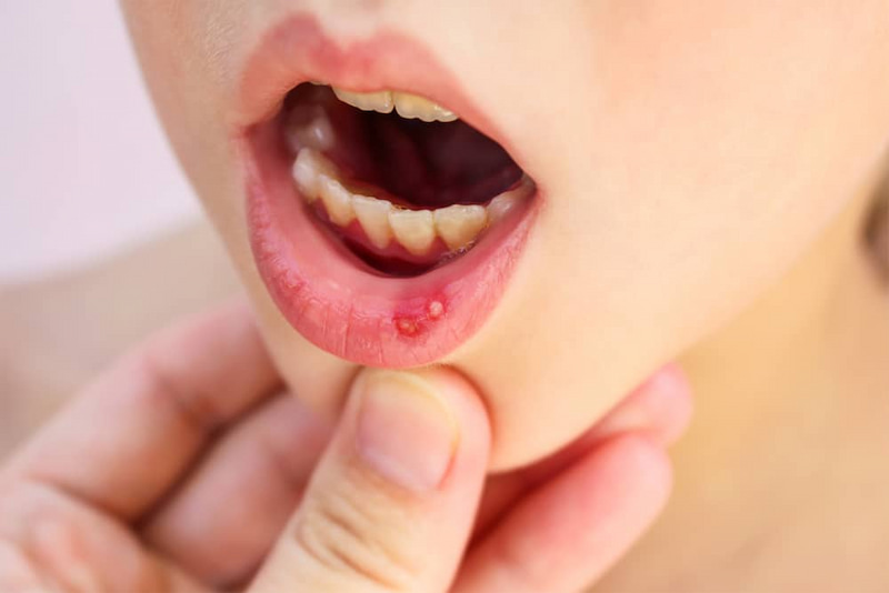 Nha Chu Tán sử dụng cho người bệnh có triệu chứng loét miệng, nhiệt miệng
