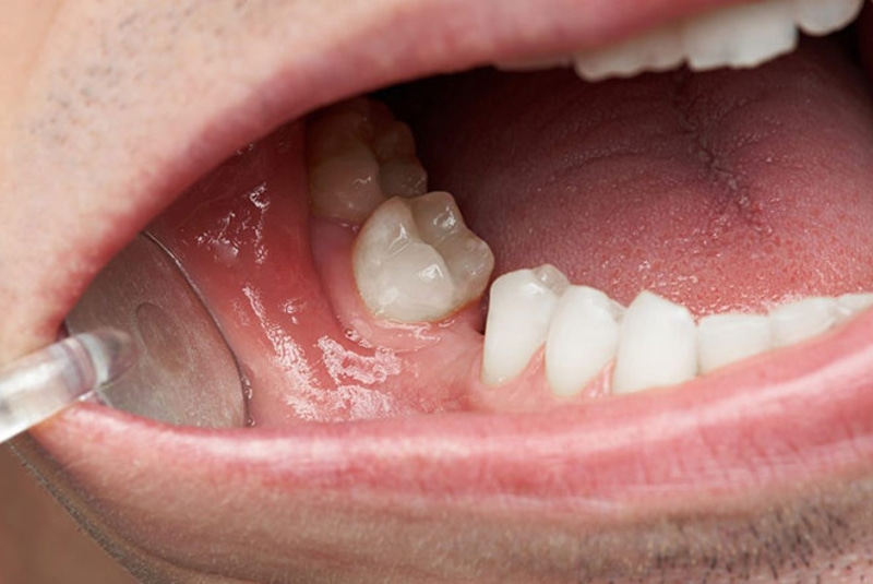 Mất răng là một trong những biến chứng nguy hiểm của viêm lợi