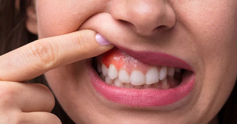 Viêm nướu răng nên ăn gì là thắc mắc của rất nhiều người