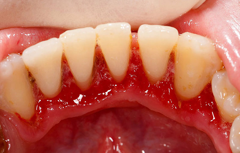 Vệ sinh răng miệng sai cách là nguyên nhân gây ra bệnh