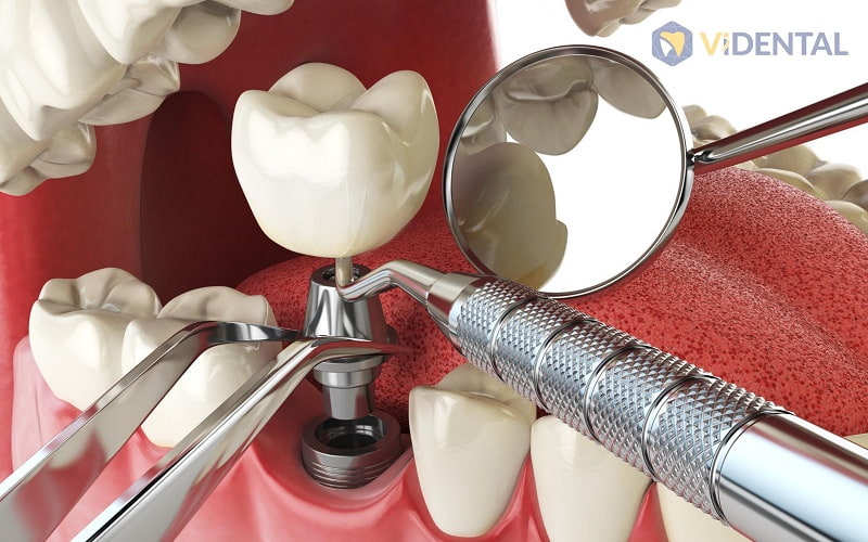 Cấy trụ ngay sau khi nhổ răng là một thao tác cực kỳ phức tạp, đòi hỏi kỹ thuật chính xác