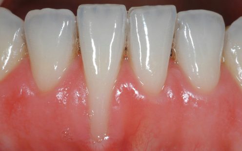 Chân Răng: Giải Đáp Về Chức Năng, Nhiệm Vụ Và Vấn Đề Thường Gặp