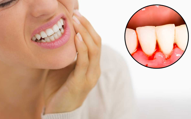 Tình trạng phần lợi xung quanh chân răng bị chảy máu gọi là chảy máu chân răng