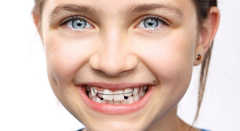 Chỉnh nha trẻ em khi các bé có hàm răng mọc lệch, không đều