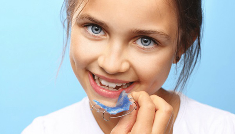 Niềng răng tháo lắp là phương pháp chỉnh nha phổ biến ở trẻ em