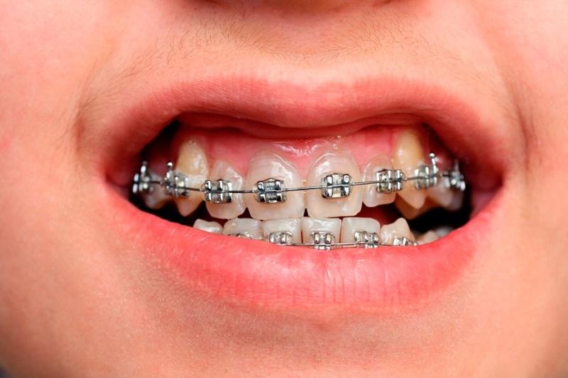 Niềng răng là một trong các phương pháp điều trị cười hở lợi ở mức độ nhẹ