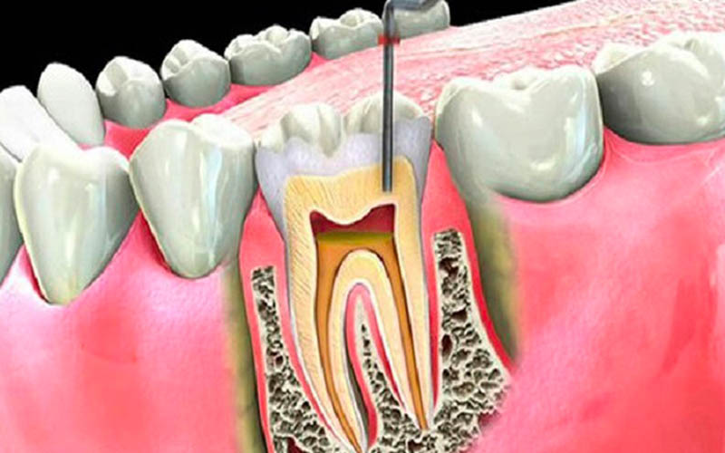Đau nhức răng kéo dài dẫn tới tình trạng viêm xương tủy hàm hết sức nguy hiểm