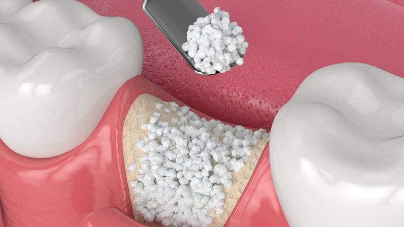 Ghép xương răng là kỹ thuật được cho những ai bị tiêu xương cần cấy ghép implant