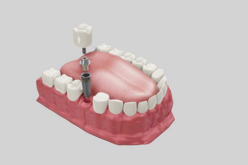 Ghép xương răng để trồng implant sẽ gây đau nhức sau khi hết thuốc tê