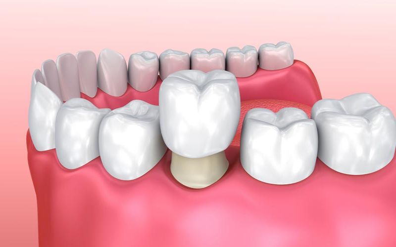 Bọc răng sứ giúp bạn có được hàm răng đều, đẹp, thẩm mỹ