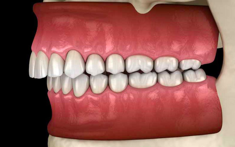 Dấu hiệu nhận biết độ cắn sâu là hàm răng trên che khuất hàm răng dưới