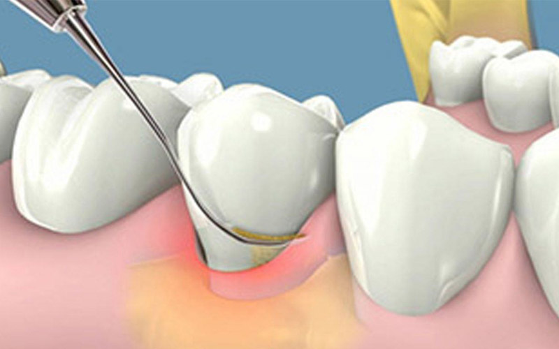 Việc lấy cao răng cần đảm bảo đúng quy trình để đạt được hiệu quả tốt nhất