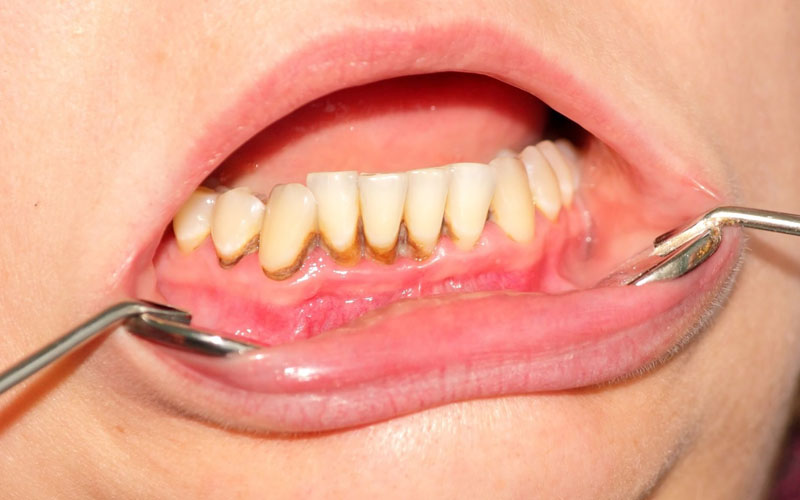 Đây chính là những mảng bám màu trắng ngà nằm ở giữa chân răng và phần nướu
