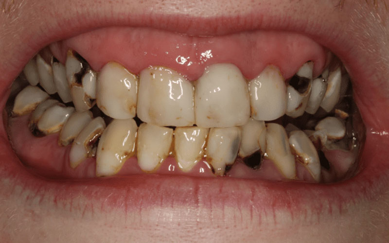 Lệch khớp cắn làm gia tăng nguy cơ mắc bệnh sâu răng