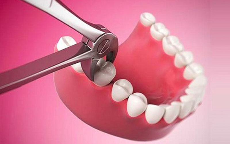 Nhổ răng là một trong những phương pháp điều trị tình trạng khớp cắn bị lệch