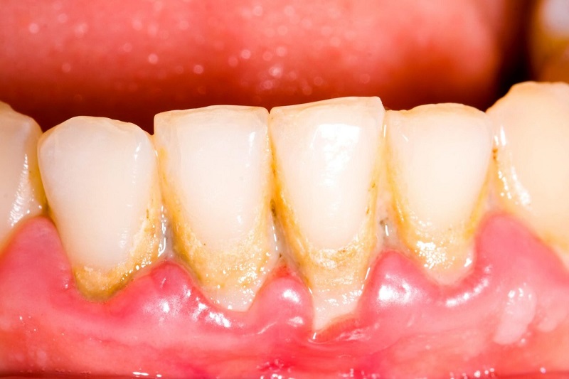 Răng Implant có tỷ lệ bị dính thức ăn cao hơn răng bình thường