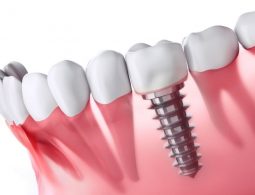 Ưu Nhược Điểm Của Trồng Răng Implant Có Thể Bạn Chưa Biết