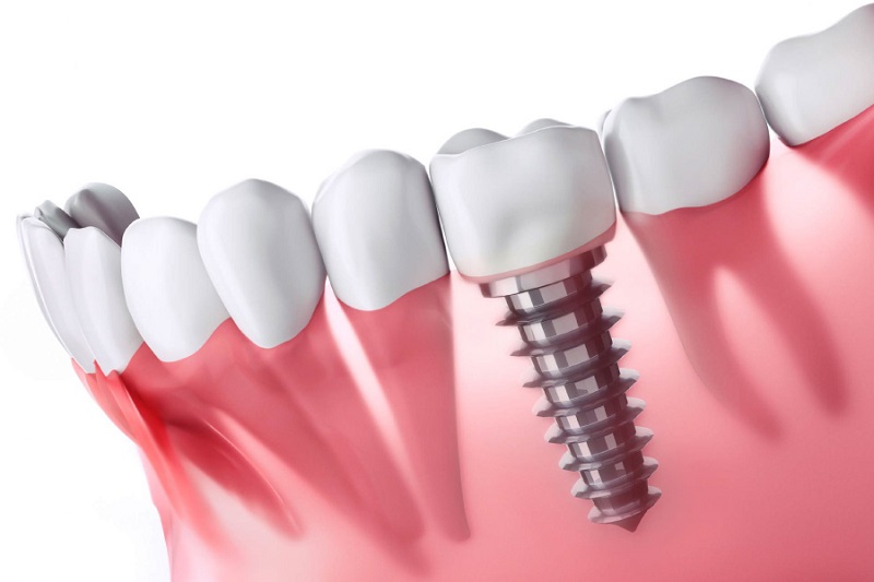 Răng trồng Implant có độ bền lâu dài