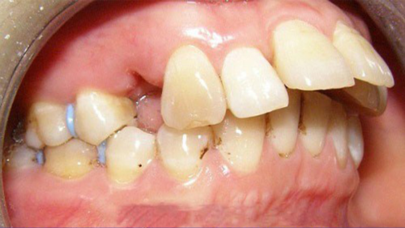 Nhổ răng trong trường hợp răng hô