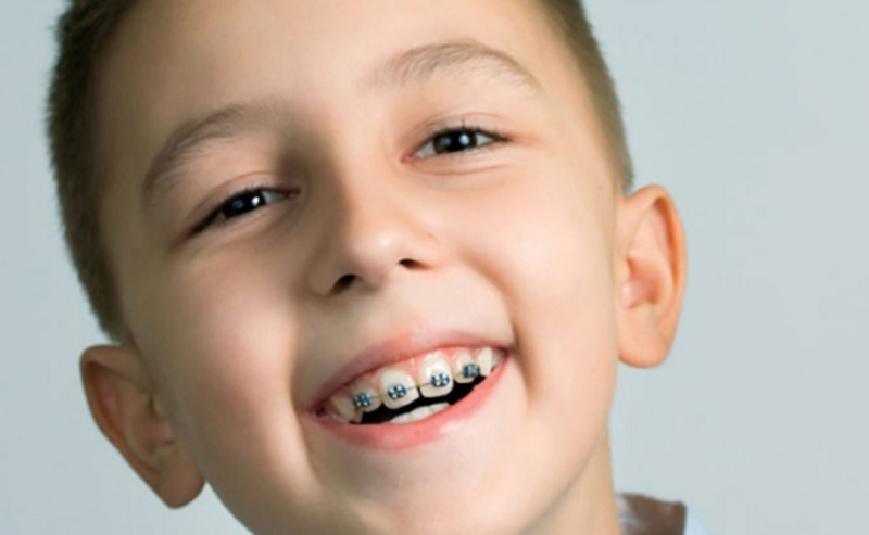 Trẻ em không cần nhổ răng trước khi niềng