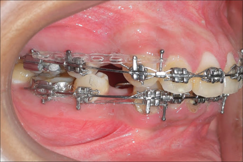 Bác sĩ thường chỉ định nhổ răng số 4, số 5 hoặc số 8