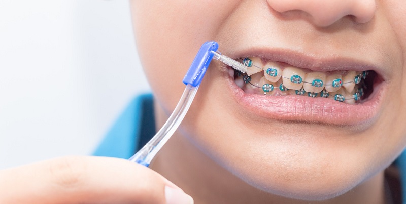 Vệ sinh đúng cách giúp bảo vệ răng miệng trong quá trình chỉnh nha