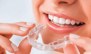 Niềng răng nhựa: Khám Các Phá Phương Pháp Hiệu Quả Và Chi Phí