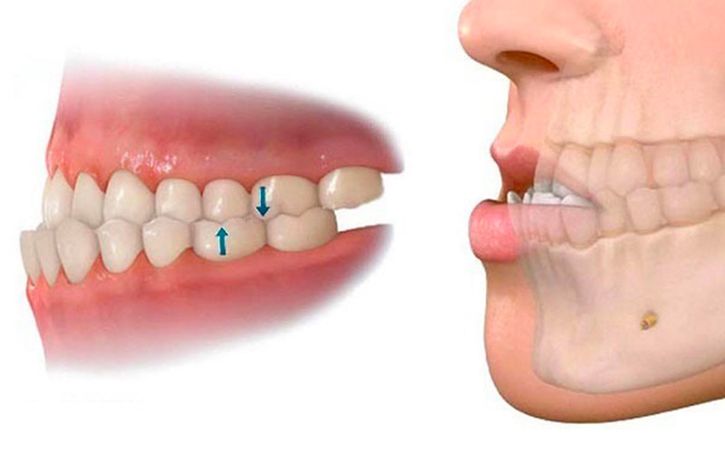 Người có vòm hàm hẹp nên thực hiện kỹ thuật nhằm tạo điều kiện để răng di chuyển thẳng hàng