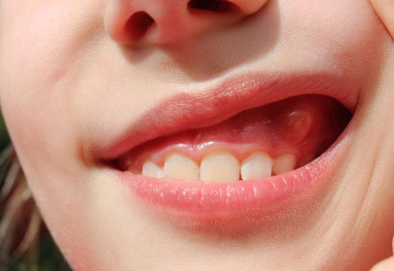 Nếu không khắc phục sớm, vết mẻ răng có thể dẫn tới một số bệnh lý răng miệng khác