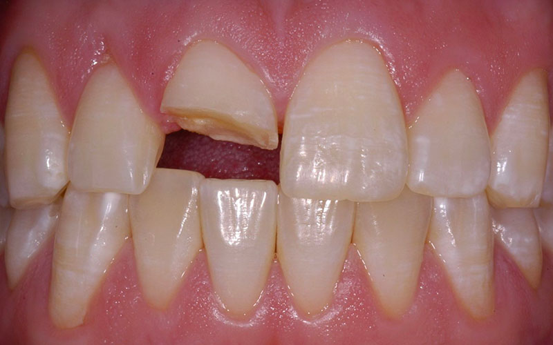 Răng bị vỡ, mẻ do nhiều nguyên nhân khác nhau