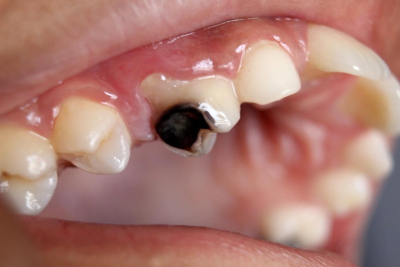 Răng chết tủy có thể gây ra nhiều biến chứng nguy hiểm như mất răng vĩnh viễn