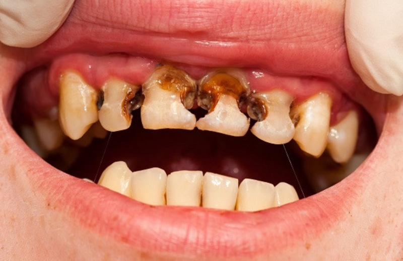 Sâu răng được coi là nguyên nhân chủ yếu dẫn tới viêm tủy răng