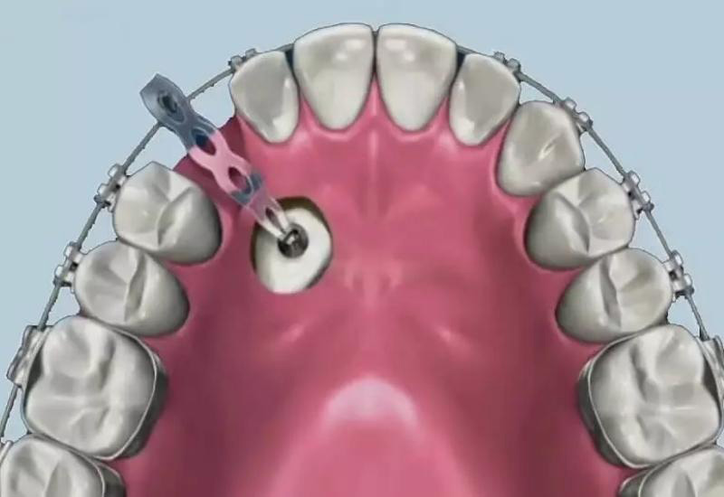 Răng mọc ngầm là tình trạng răng mọc sâu bên trong và không thể trồi lên được