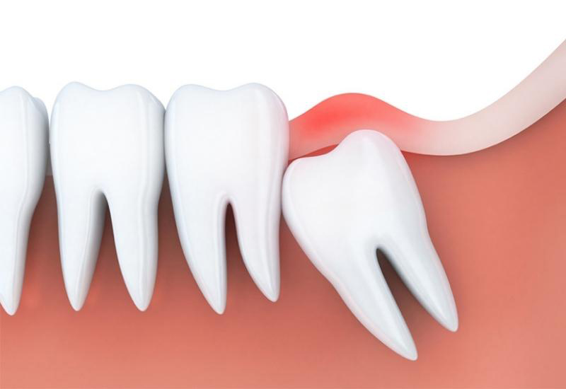 Nguyên nhân khiến răng khôn mọc lệch là do không còn khoảng trống trên cung hàm
