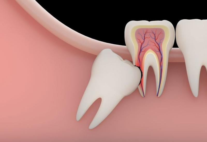 Răng khôn mọc ngầm có thể gây tổn thương tới răng số 7