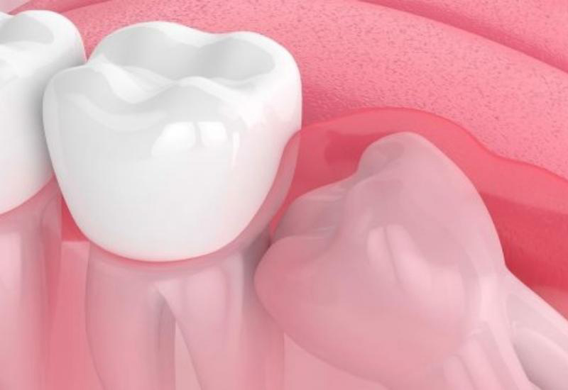 Răng mọc sâu bên trong mà không gây biến chứng nguy hiểm thì không cần thiết phải nhổ