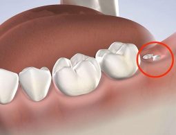 Răng mọc ngầm có gây nguy hiểm không? Dấu hiệu và cách điều trị