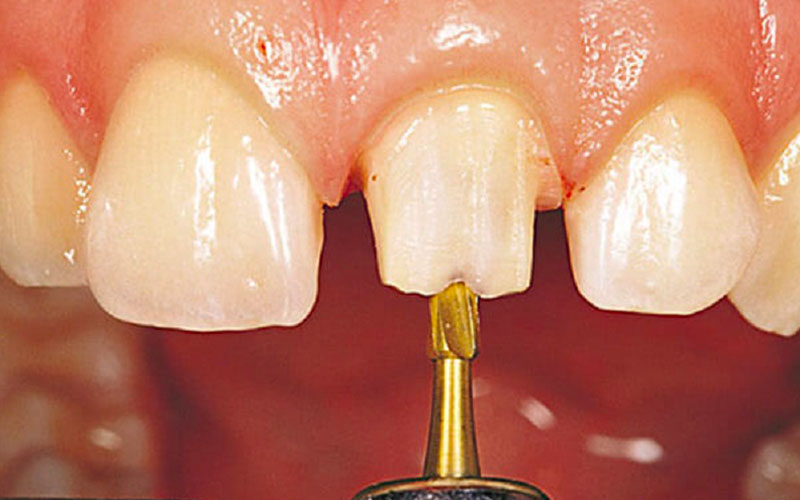 Mài răng là bước đầu tiên trong quá trình bọc sứ