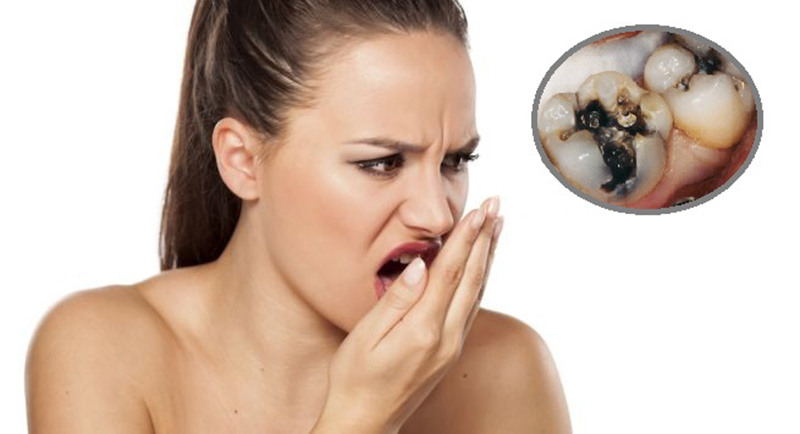 Sâu răng hôi miệng là bệnh lý thường gặp ở nhiều lứa tuổi