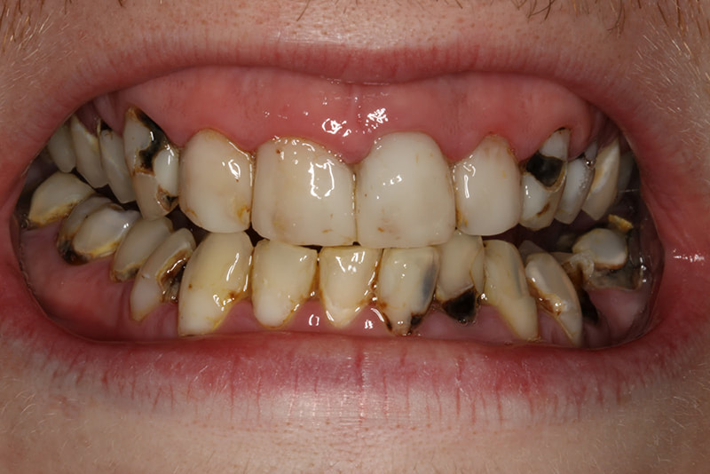 Sâu răng gây mất thẩm mỹ