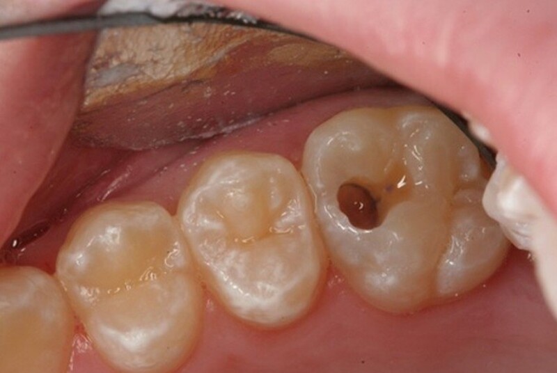 Vi khuẩn có thể xâm nhập sâu vào răng thông qua các lỗ sâu