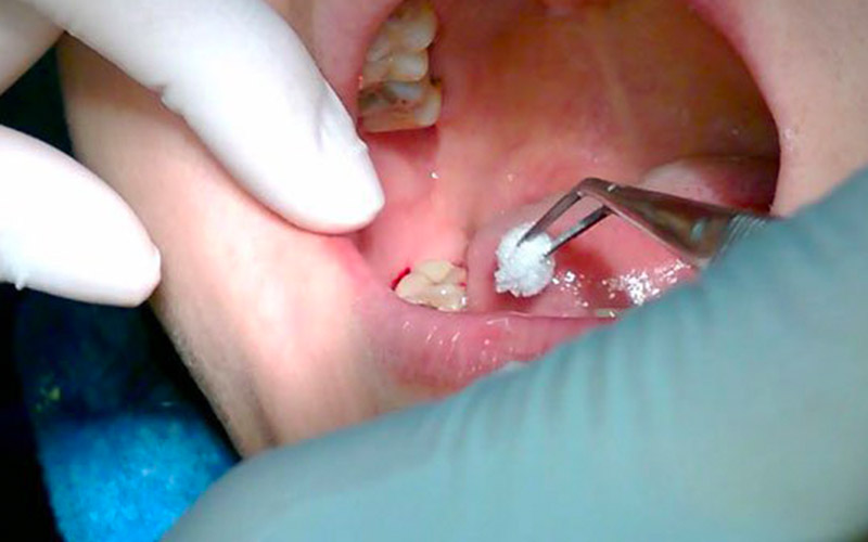 Nhổ răng khôn là biện pháp điều trị tình trạng sưng nướu răng trong cùng