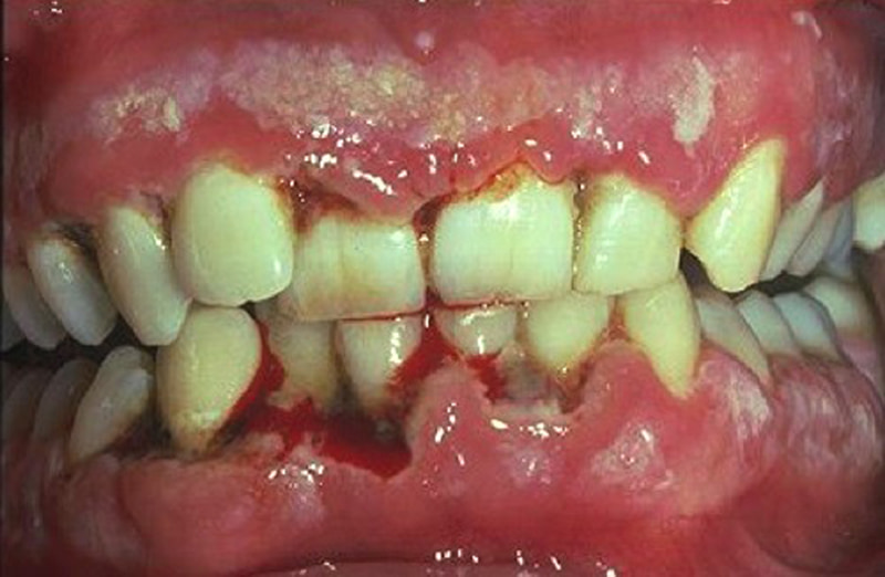 Tình trạng hoại tử nướu răng