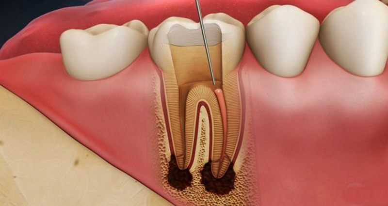 Viêm tủy răng cần được điều trị càng sớm càng tốt
