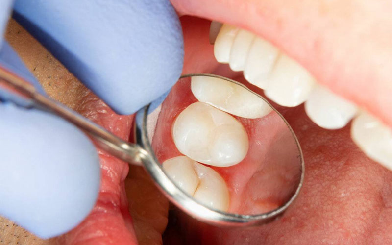 Trám răng thẩm mỹ có đau không phụ thuộc vào nhiều yếu tố