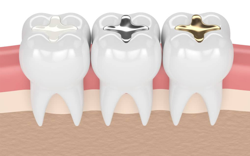 Một số phương pháp trám răng phổ biến hiện nay