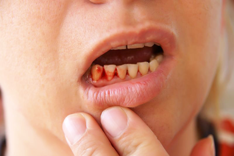 Sưng lợi chảy máu chân răng ở trẻ em
