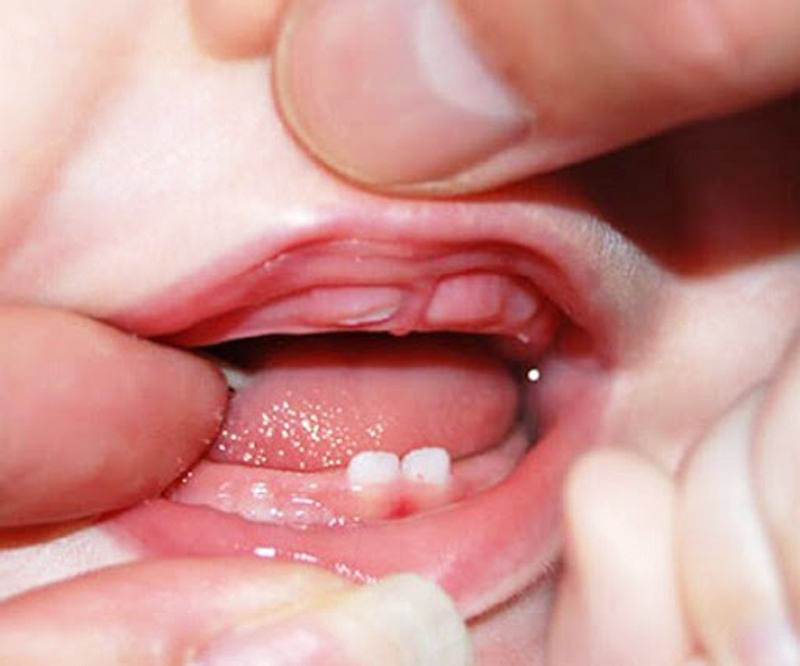 Mọc răng cũng khiến trẻ bị sưng lợi và chảy máu