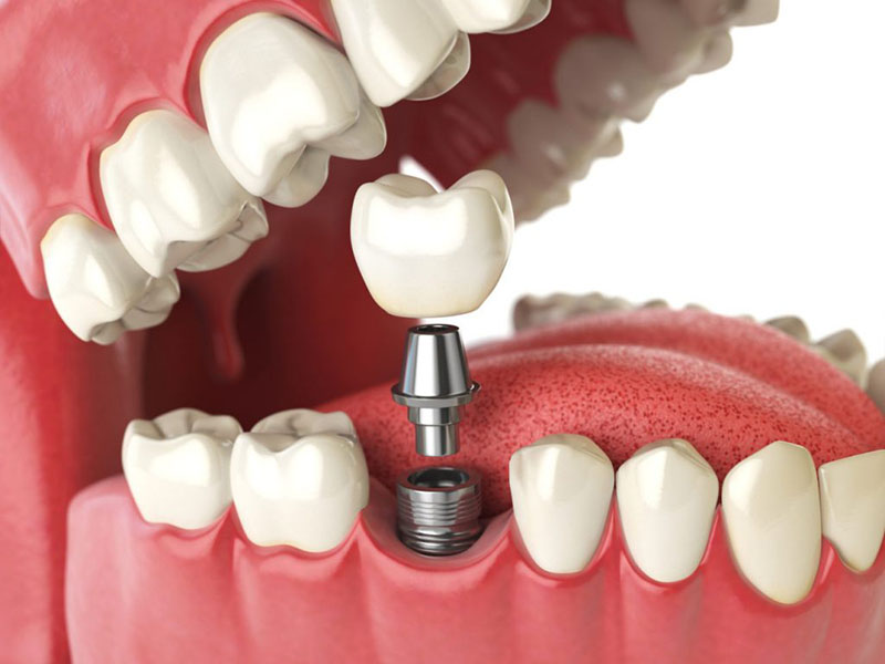 Bạn cần lưu ý với những quảng cáo trồng răng implant miễn phí, giá rẻ